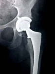 hip replacement pre settlement loan